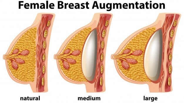 Andrew Trussler Breast Enhancement