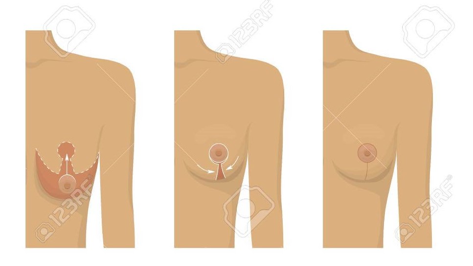 Breast fat transfer lift asymmetrical nipple sag Vector Image